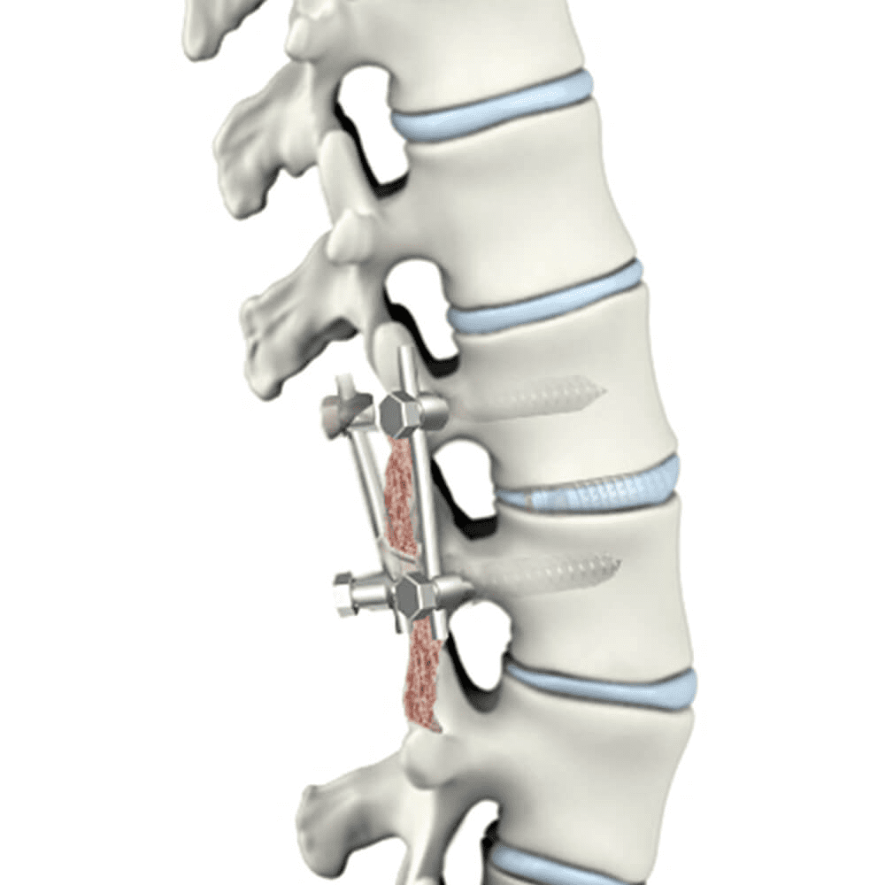 Χειρουργική σπονδυλικής στήλης