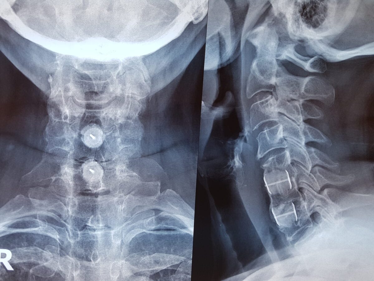 Αυχενική στένωση - σπονδύλωση