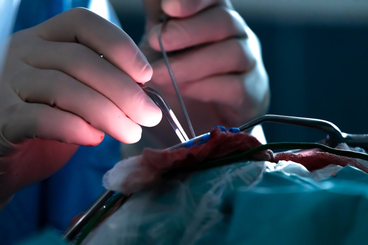 Γλοίωμα εγκεφαλικού στελέχους