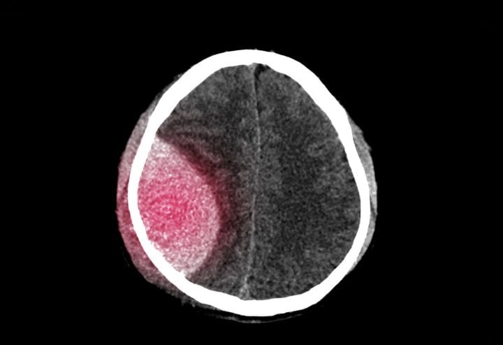 νευροχειρουργική τραυματιολογία