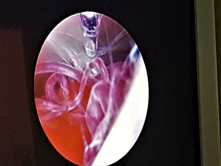 Ενδοσκοπική νευροχειρουργική