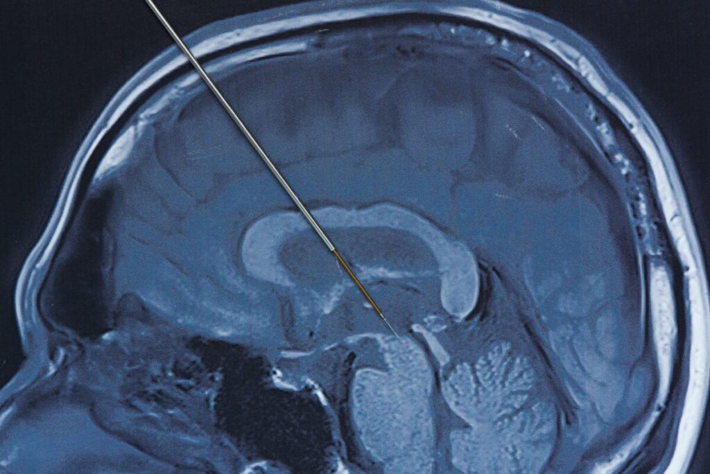 Νόσος Parkinson