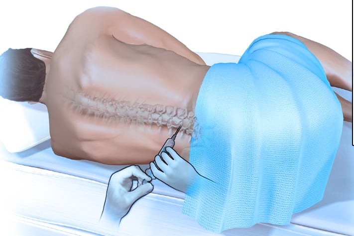 οσφυονωτιαία παρακέντηση