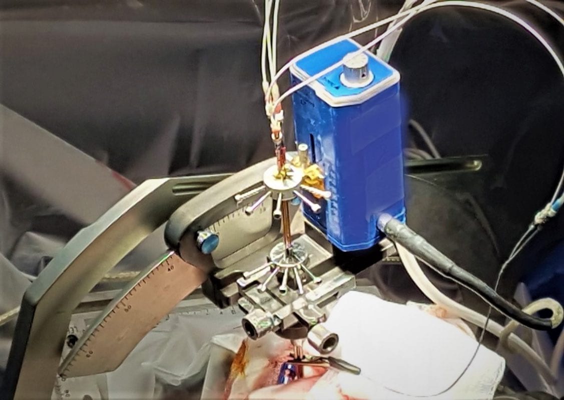 Στερεοτακτική βιοψία εγκεφάλου